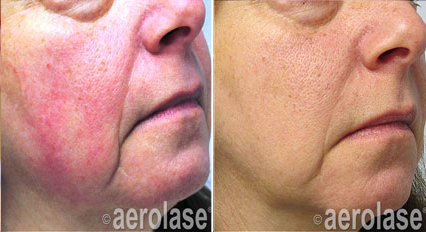 Cheek with pronounced rosacea redness before treatment, and markedly calmer
                after one NeoSkin treatment.