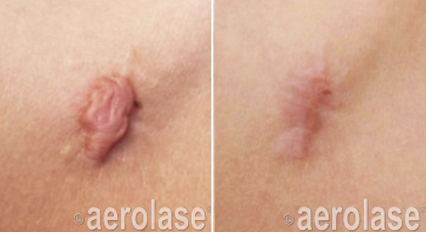 Raised scar before treatment, visibly flatter and less raised after NeoSkin
                treatment.