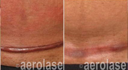 A wide surgical scar before treatment, noticeably softer and less pigmented
                after NeoSkin treatment.